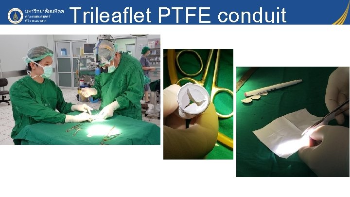 Trileaflet PTFE conduit 