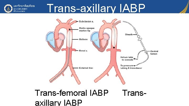 Trans-axillary IABP Trans-femoral IABP axillary IABP Trans- 