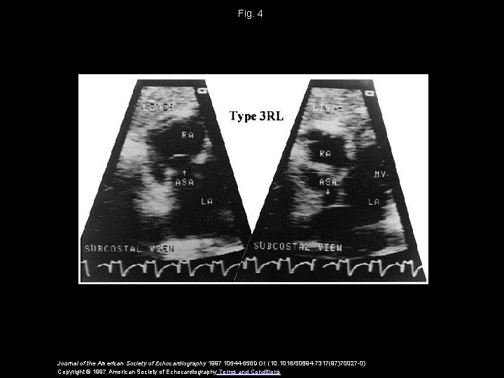 Fig. 4 Journal of the American Society of Echocardiography 1997 10644 -656 DOI: (10.