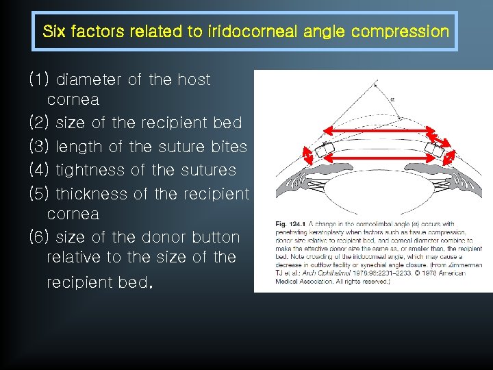 Six factors related to iridocorneal angle compression (1) diameter of the host cornea (2)