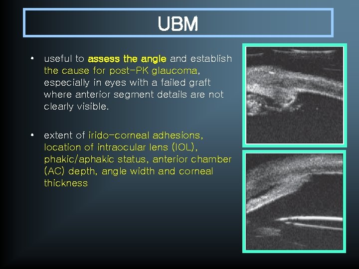 UBM • useful to assess the angle and establish the cause for post-PK glaucoma,