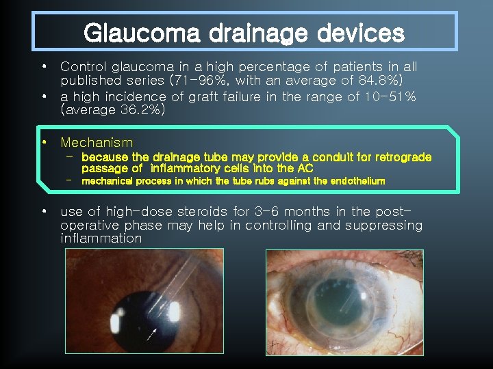 Glaucoma drainage devices • Control glaucoma in a high percentage of patients in all