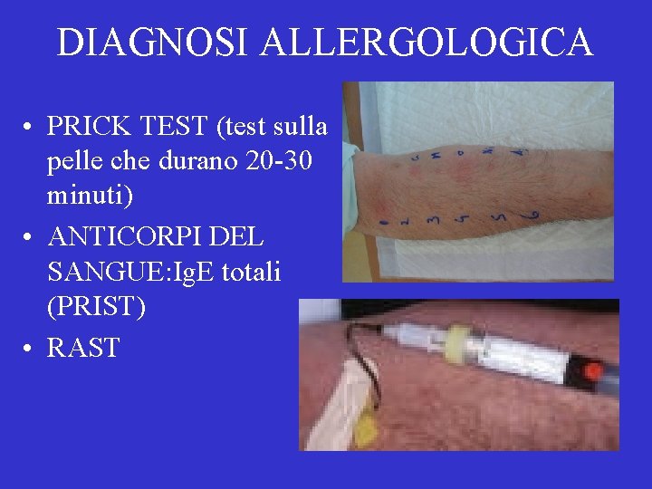 DIAGNOSI ALLERGOLOGICA • PRICK TEST (test sulla pelle che durano 20 -30 minuti) •