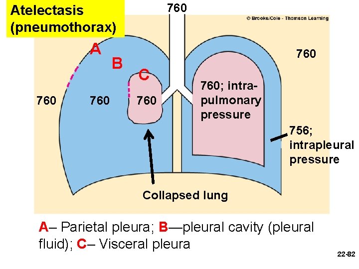 760 Atelectasis (pneumothorax) A 760 B 760 C 760; intrapulmonary pressure 756; intrapleural pressure