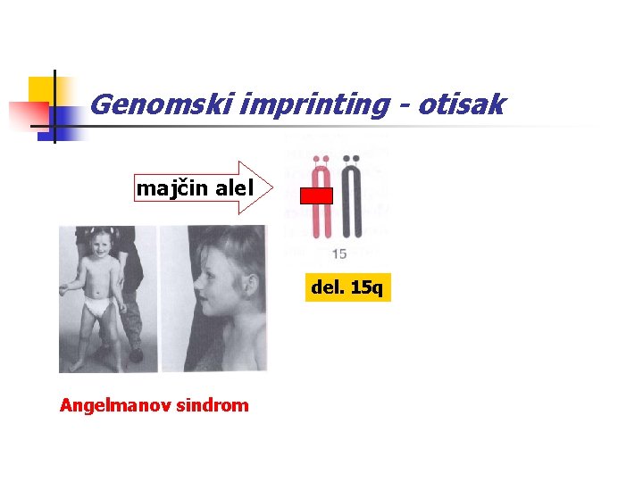 Genomski imprinting - otisak majčin alel del. 15 q Angelmanov sindrom 