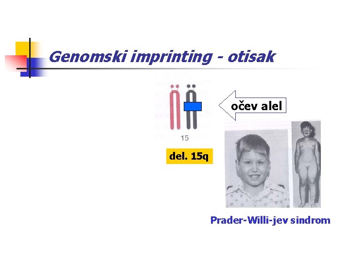 Genomski imprinting - otisak očev alel del. 15 q Prader-Willi-jev sindrom 