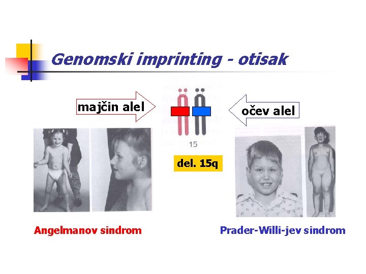 Genomski imprinting - otisak majčin alel očev alel del. 15 q Angelmanov sindrom Prader-Willi-jev