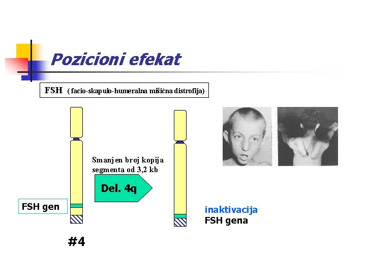 Pozicioni efekat FSH ( facio-skapulo-humeralna mišićna distrofija) Smanjen broj kopija segmenta od 3, 2