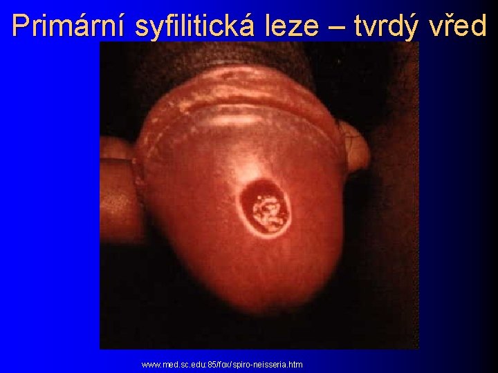 Primární syfilitická leze – tvrdý vřed www. med. sc. edu: 85/fox/spiro-neisseria. htm 