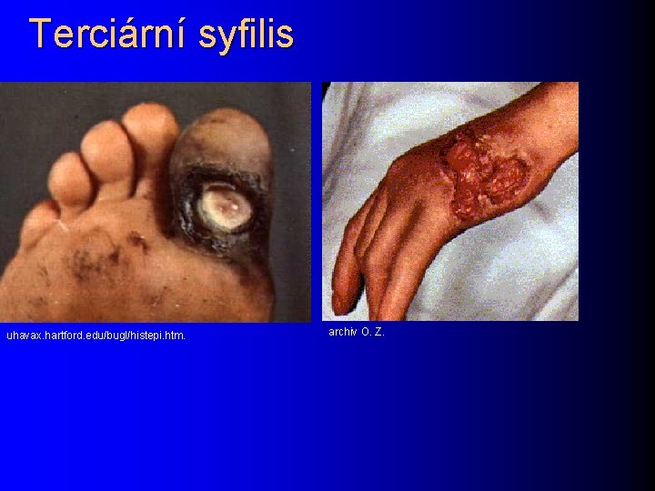 Terciární syfilis uhavax. hartford. edu/bugl/histepi. htm. archiv O. Z. 