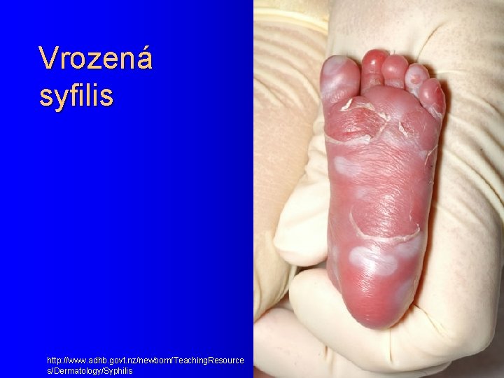 Vrozená syfilis http: //www. adhb. govt. nz/newborn/Teaching. Resource s/Dermatology/Syphilis 