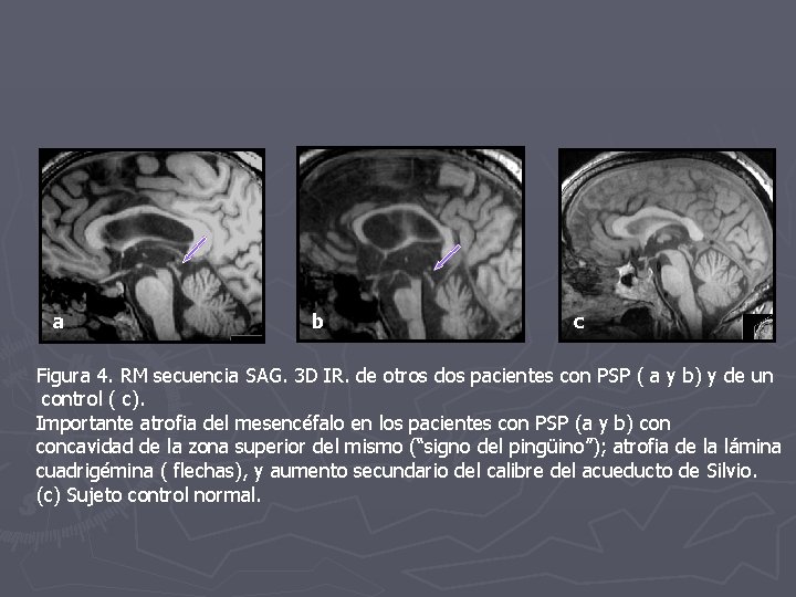 a b c Figura 4. RM secuencia SAG. 3 D IR. de otros dos