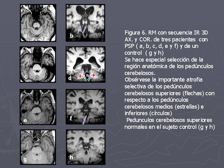 a b c d e f g h Figura 6. RM con secuencia IR