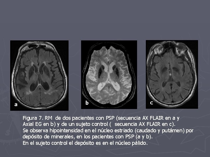 a b c Figura 7. RM de dos pacientes con PSP (secuencia AX FLAIR