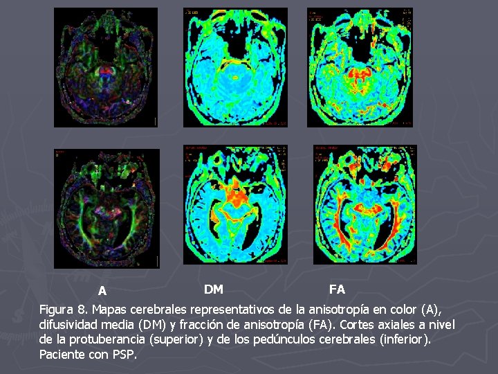 A DM FA Figura 8. Mapas cerebrales representativos de la anisotropía en color (A),