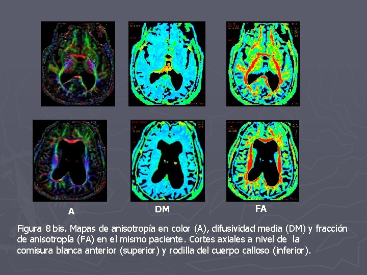 A DM FA Figura 8 bis. Mapas de anisotropía en color (A), difusividad media