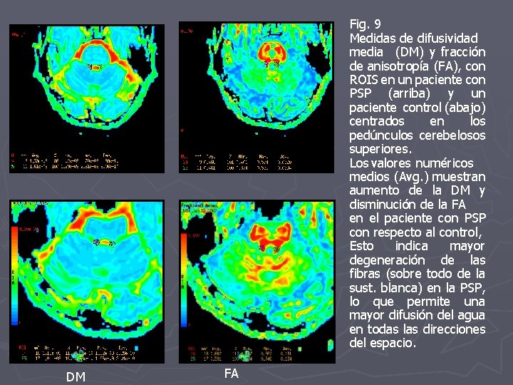 Fig. 9 Medidas de difusividad media (DM) y fracción de anisotropía (FA), con ROIS