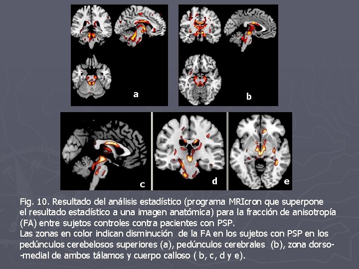 a b c d e Fig. 10. Resultado del análisis estadístico (programa MRIcron que