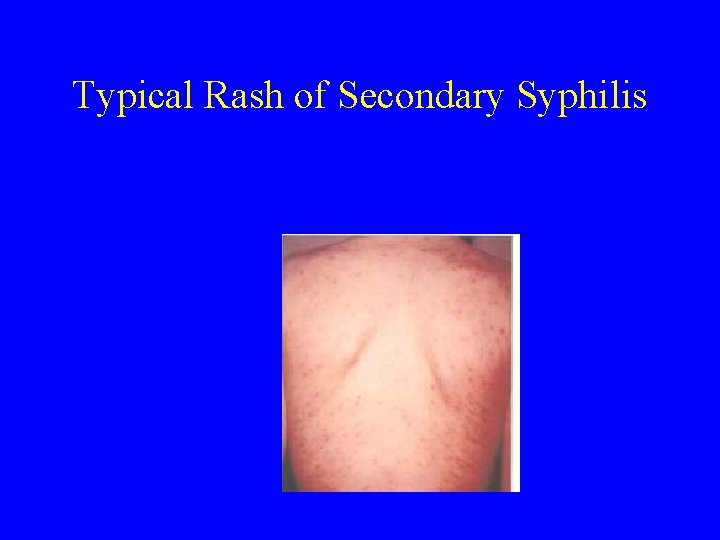 Typical Rash of Secondary Syphilis 