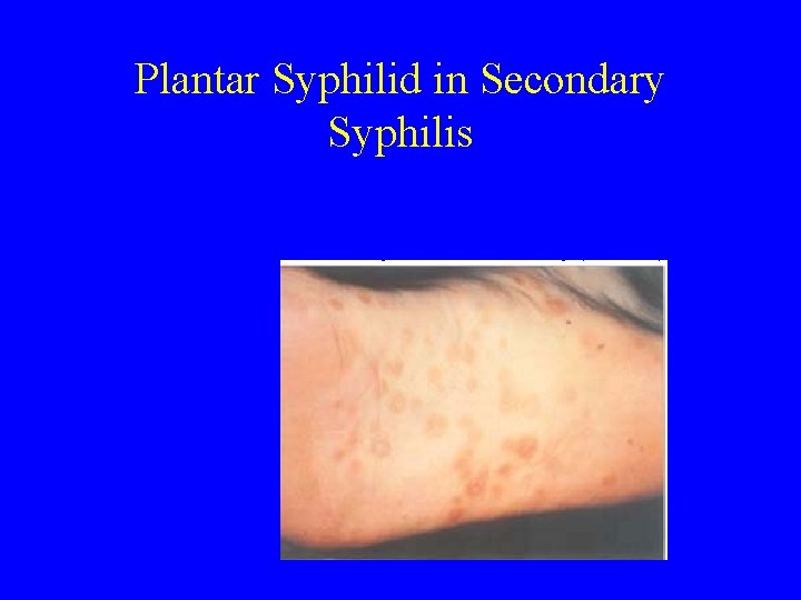 Plantar Syphilid in Secondary Syphilis 