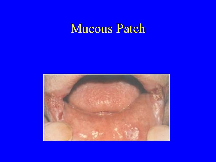 Mucous Patch 