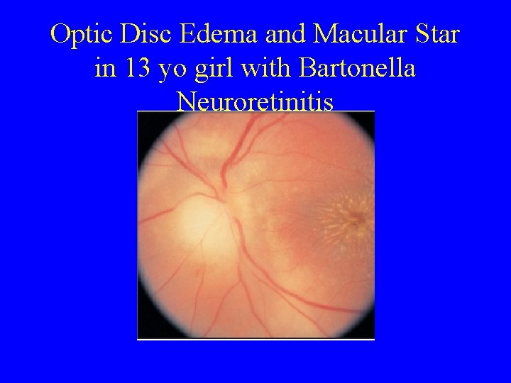 Optic Disc Edema and Macular Star in 13 yo girl with Bartonella Neuroretinitis 