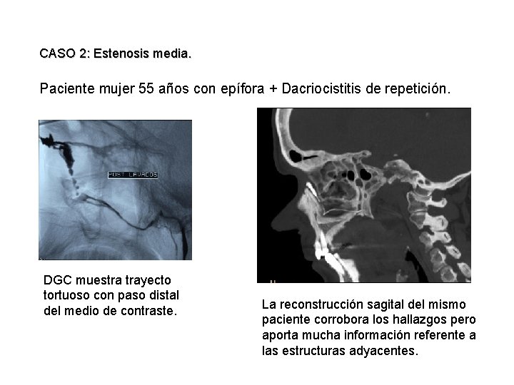 CASO 2: Estenosis media. Paciente mujer 55 años con epífora + Dacriocistitis de repetición.