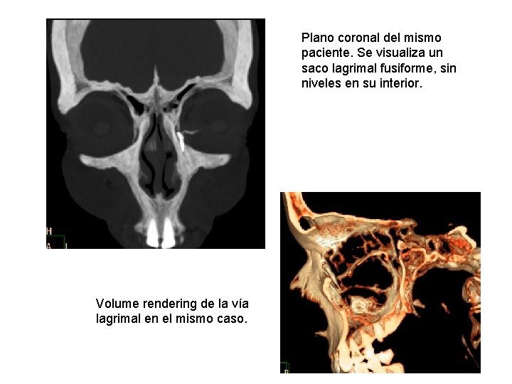 Plano coronal del mismo paciente. Se visualiza un saco lagrimal fusiforme, sin niveles en