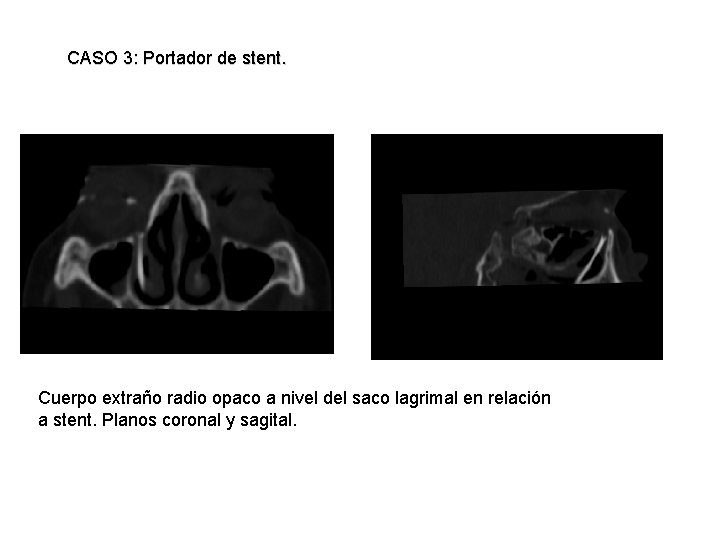 CASO 3: Portador de stent. Cuerpo extraño radio opaco a nivel del saco lagrimal