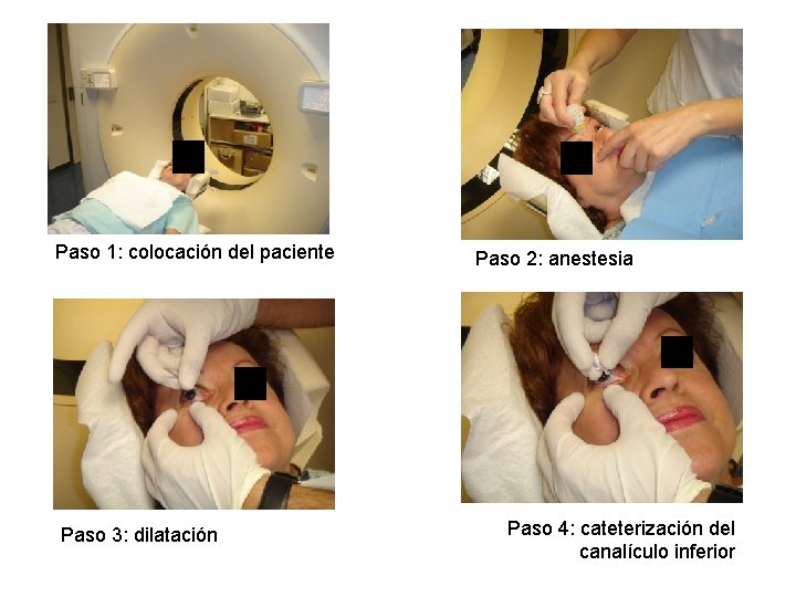 Paso 1: colocación del paciente Paso 3: dilatación Paso 2: anestesia Paso 4: cateterización