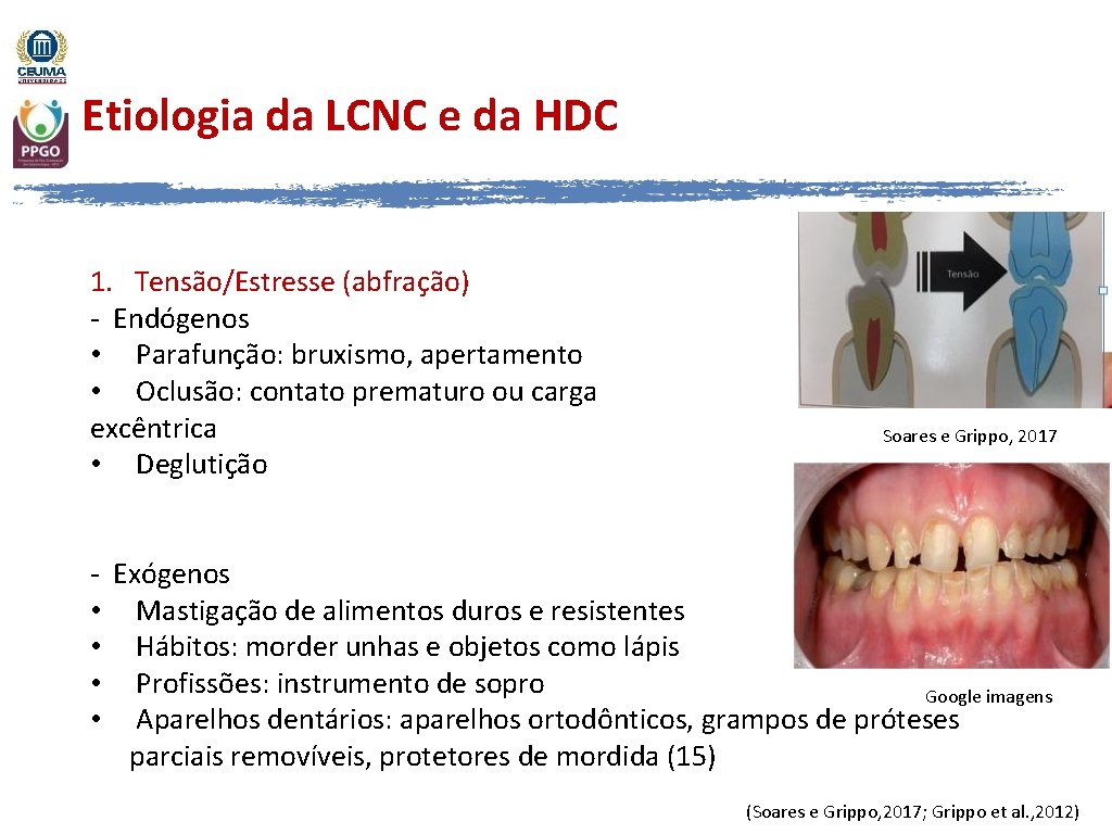 Etiologia da LCNC e da HDC 1. Tensão/Estresse (abfração) - Endógenos • Parafunção: bruxismo,