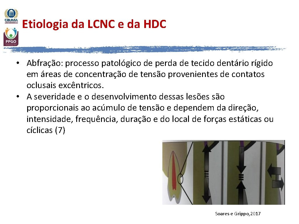 Etiologia da LCNC e da HDC • Abfração: processo patológico de perda de tecido