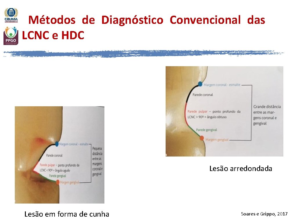 Métodos de Diagnóstico Convencional das LCNC e HDC Lesão arredondada Lesão em forma de