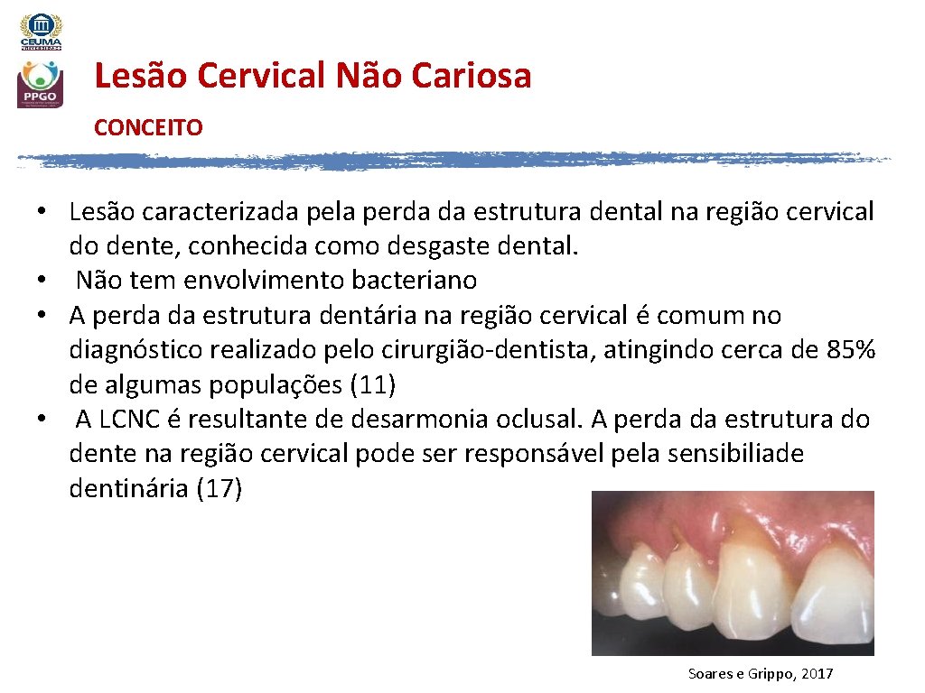 Lesão Cervical Não Cariosa CONCEITO • Lesão caracterizada pela perda da estrutura dental na