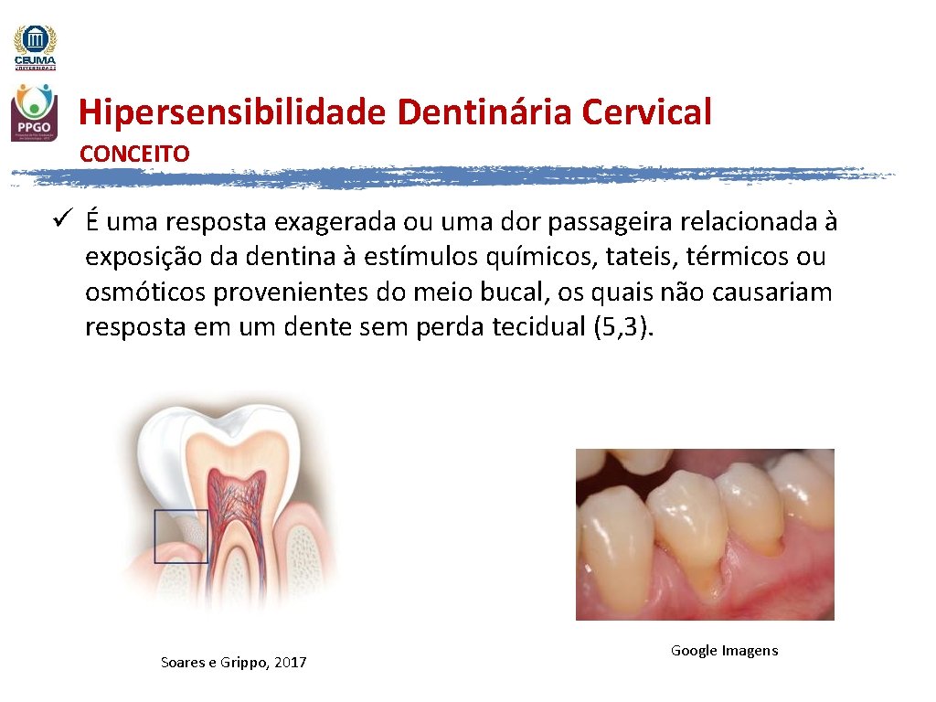 Hipersensibilidade Dentinária Cervical CONCEITO ü É uma resposta exagerada ou uma dor passageira relacionada