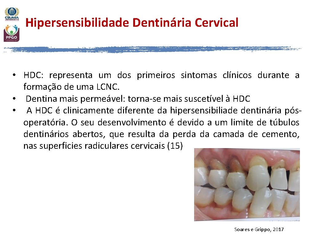 Hipersensibilidade Dentinária Cervical • HDC: representa um dos primeiros sintomas clínicos durante a formação