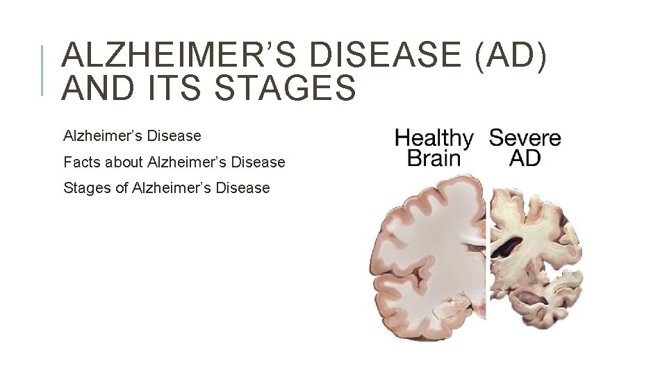 ALZHEIMER’S DISEASE (AD) AND ITS STAGES Alzheimer’s Disease Facts about Alzheimer’s Disease Stages of