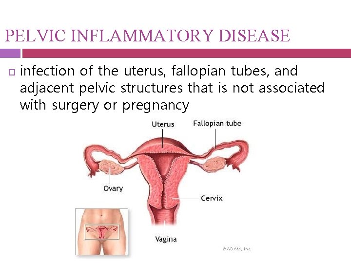 PELVIC INFLAMMATORY DISEASE infection of the uterus, fallopian tubes, and adjacent pelvic structures that