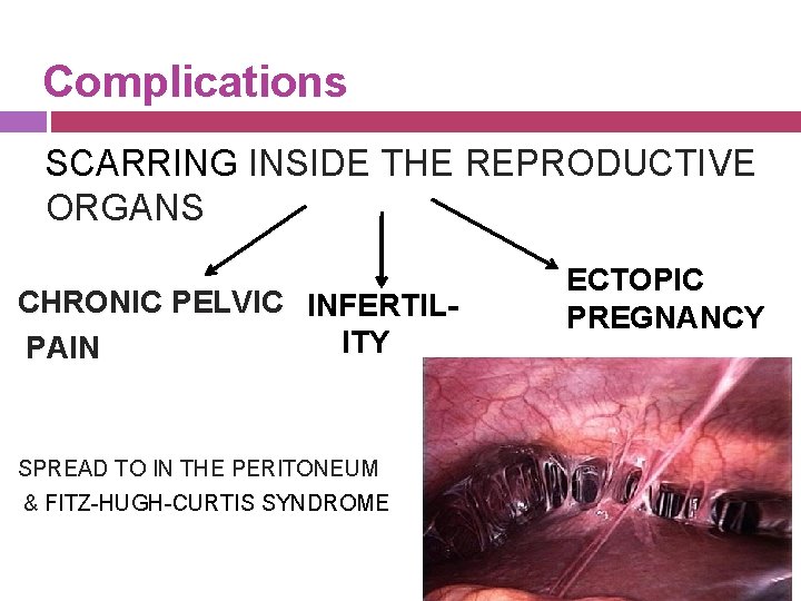 Complications SCARRING INSIDE THE REPRODUCTIVE ORGANS CHRONIC PELVIC INFERTILITY PAIN SPREAD TO IN THE