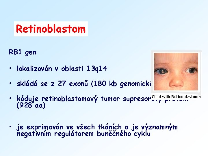 Retinoblastom RB 1 gen • lokalizován v oblasti 13 q 14 • skládá se