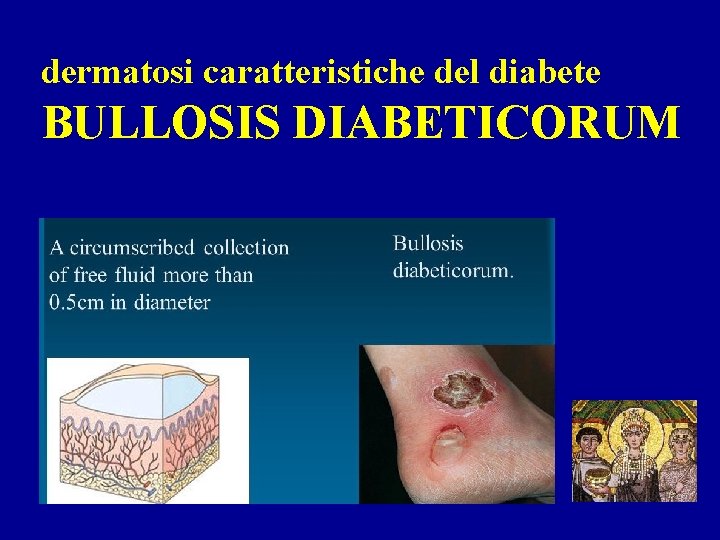 dermatosi caratteristiche del diabete BULLOSIS DIABETICORUM 