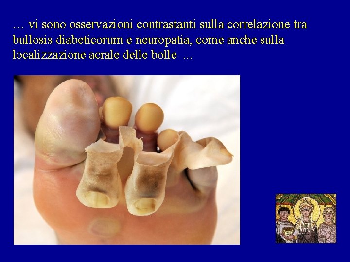 … vi sono osservazioni contrastanti sulla correlazione tra bullosis diabeticorum e neuropatia, come anche