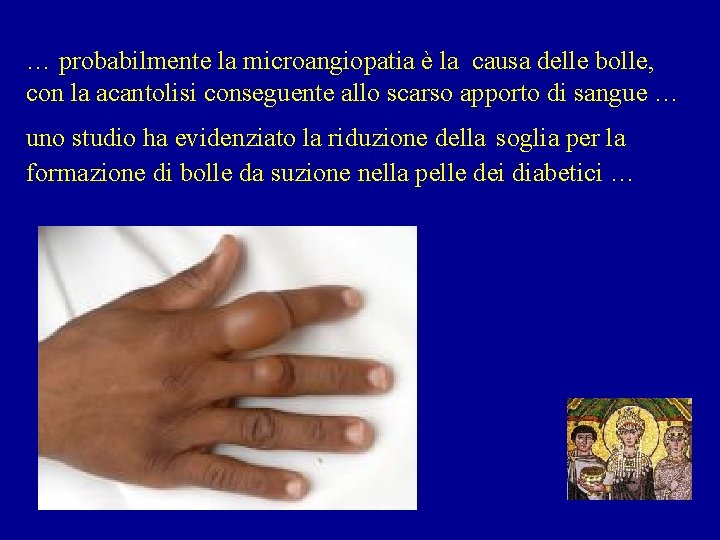 … probabilmente la microangiopatia è la causa delle bolle, con la acantolisi conseguente allo