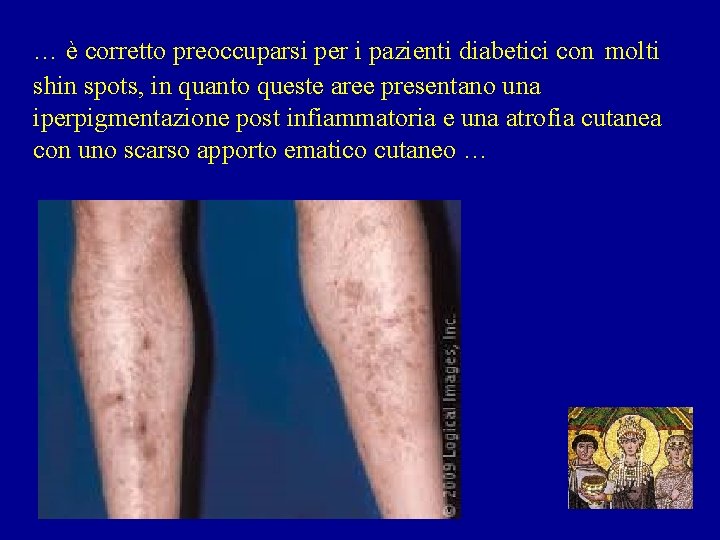 … è corretto preoccuparsi per i pazienti diabetici con molti shin spots, in quanto