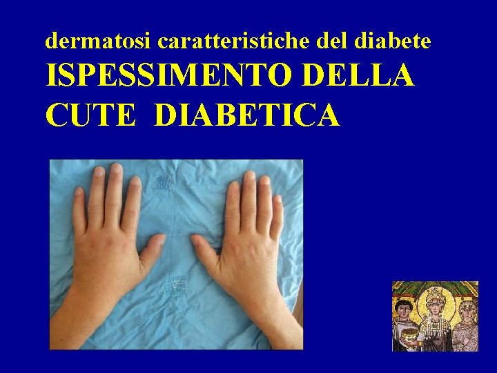 dermatosi caratteristiche del diabete ISPESSIMENTO DELLA CUTE DIABETICA 