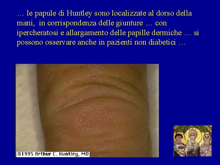 … le papule di Huntley sono localizzate al dorso della mani, in corrispondenza delle