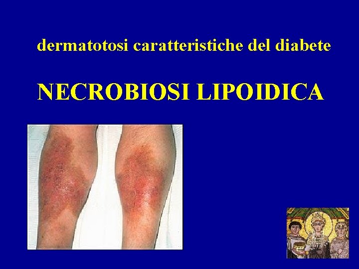 dermatotosi caratteristiche del diabete NECROBIOSI LIPOIDICA 