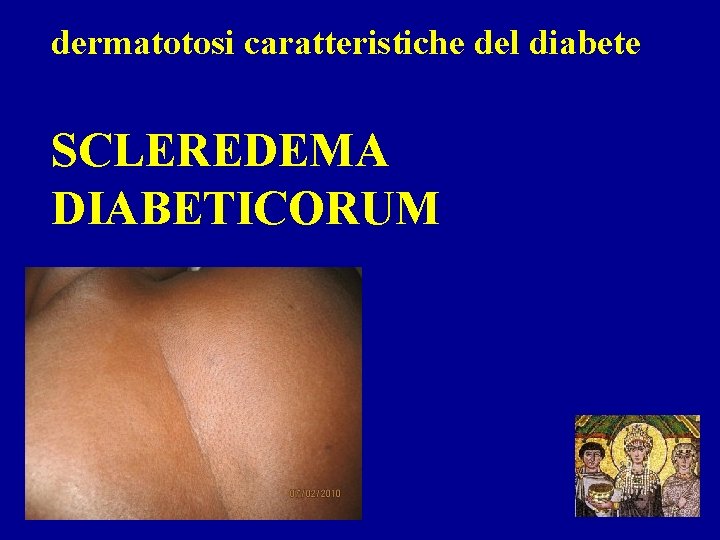 dermatotosi caratteristiche del diabete SCLEREDEMA DIABETICORUM 