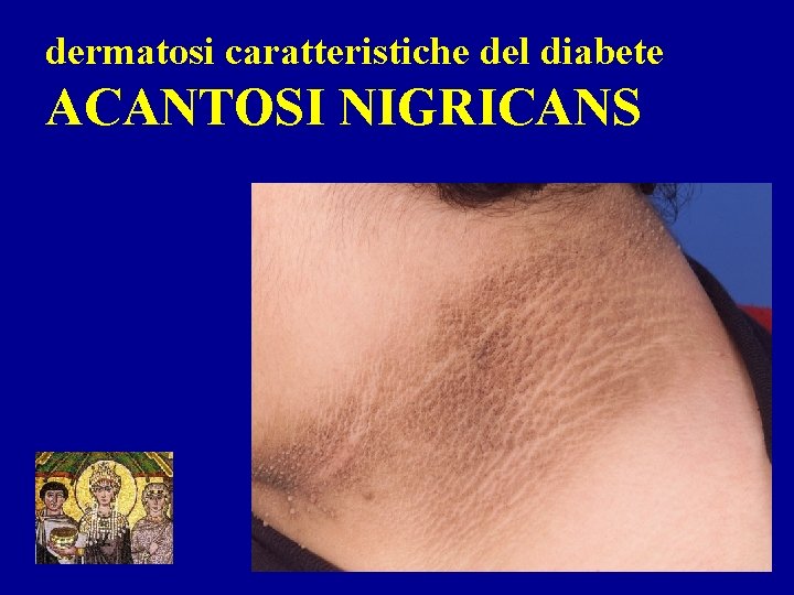 dermatosi caratteristiche del diabete ACANTOSI NIGRICANS 