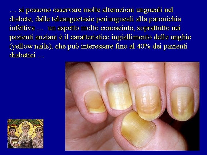 … si possono osservare molte alterazioni ungueali nel diabete, dalle teleangectasie periungueali alla paronichia